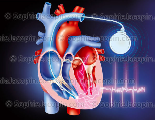 Stimulateur cardiaque