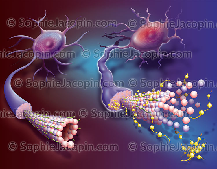 Alzheimer - Illustration Médicale - Sophie Jacopin