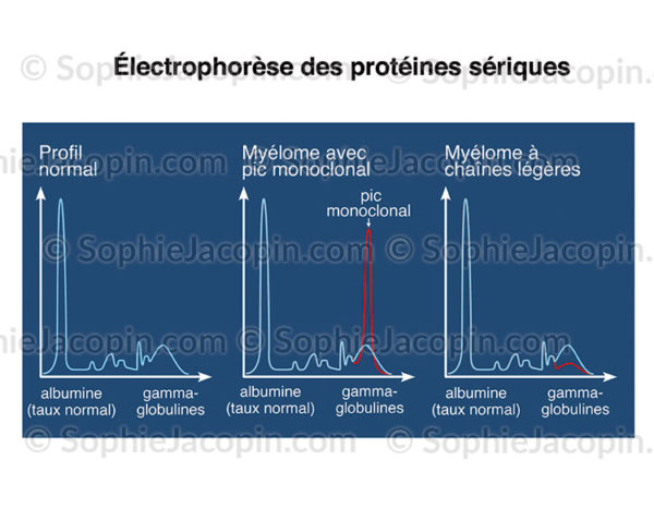 Électrophorèse des protéines sériques