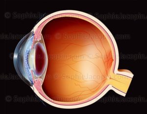 Cataracte sous capsulaire antérieure