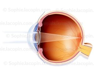 Traitement cataracte-glaucome