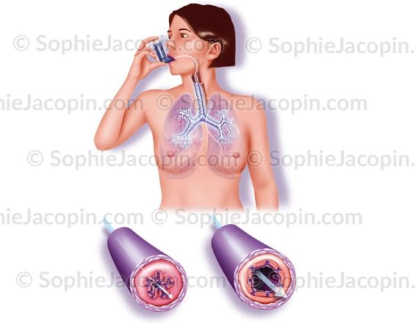 Illustration medicale Crise d'asthme