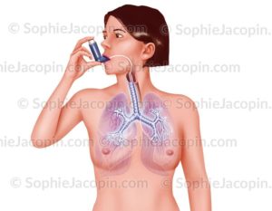 Illustration medicale Traitement asthme