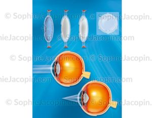 Implant oculaire électrique