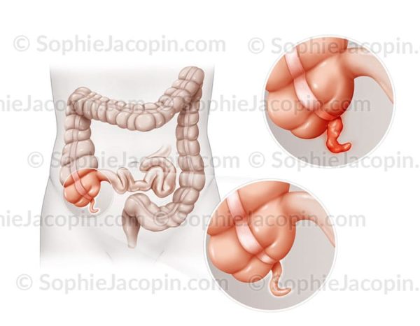 Appendicite - Illustration medicale