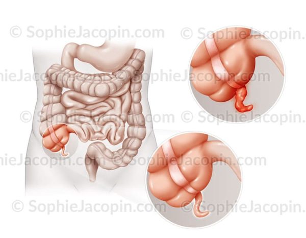Appendicite - Illustrations médicales