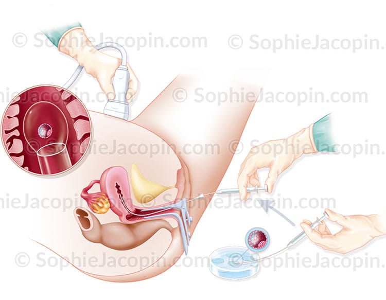 Illustration medicale_Transfert d'embryon