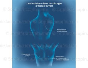 Incisions chirurgicales pulmonaires