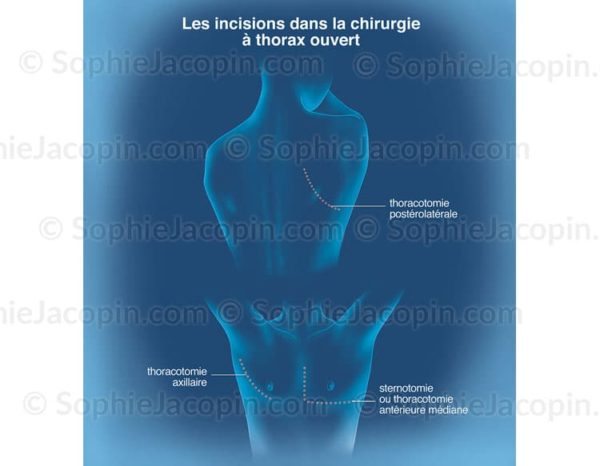 Incisions chirurgicales pulmonaires