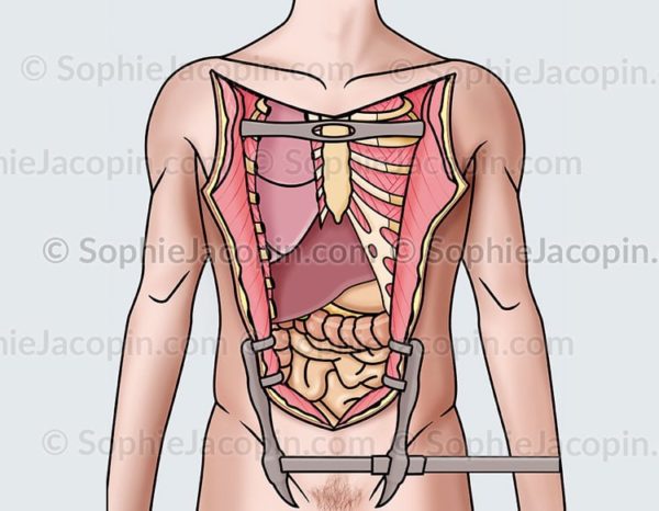 Autopsie ouverture thorax