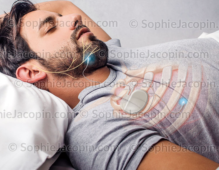 Traitement apnée du sommeil - Dessin/photo