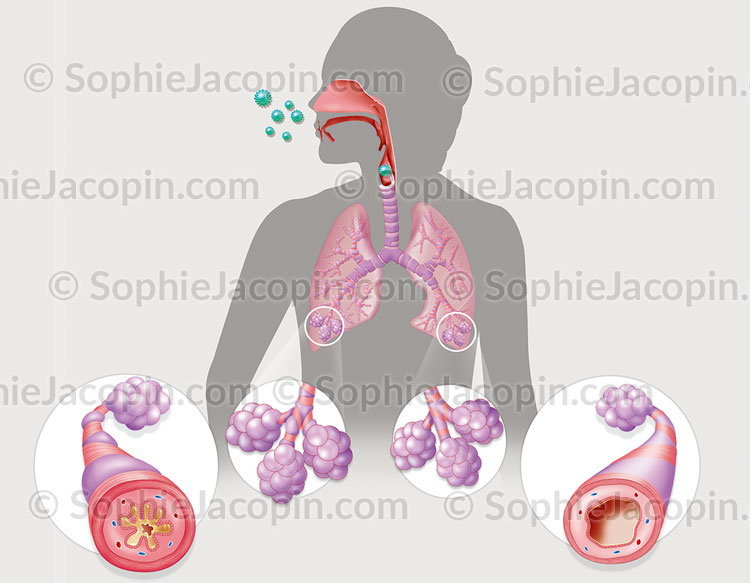 Illustration médicale - Asthme Illustration médicale - Asthme
