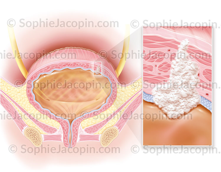 Cancer-de la vessie - Illustration-medicale cancer vessie-illustration médicale-© sophie jacopin