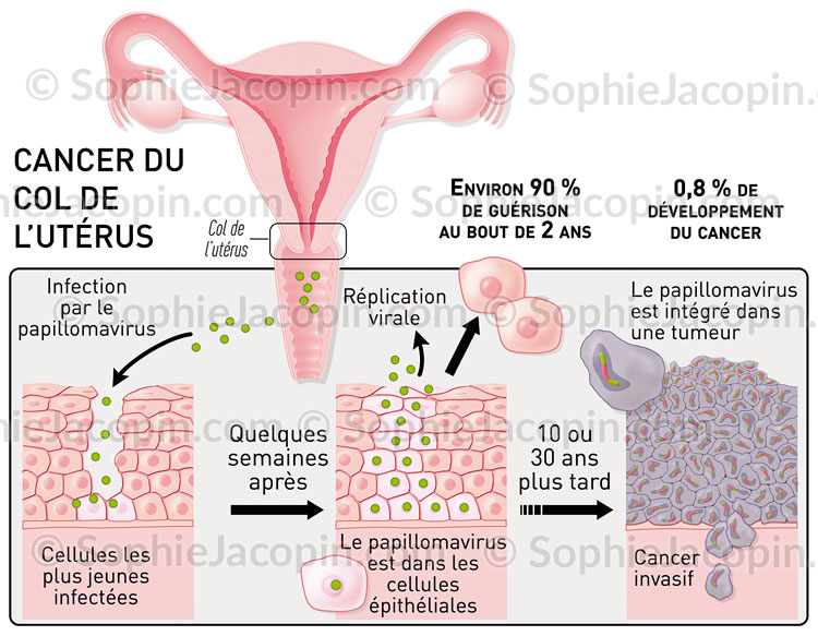 Infection au papillomavirus cancer du col de l'utérus infection au papillomavirus cancer du col de l'utérus - illustration médicale © sophie jacopin