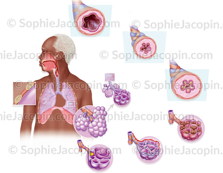Illustration medicale_Maladies pulmonaires