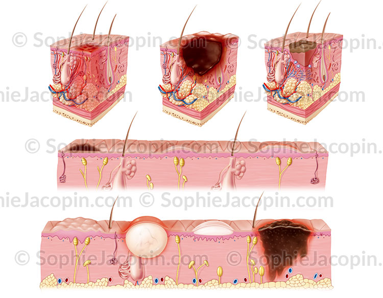 Pathologies-peau pathologies de la peau - illustration médicale © sophie jacopin