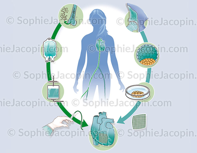 Traitement-coeur traitement-coeur-illustration médicale-© sophie jacopin