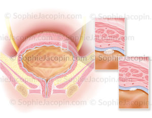 Cancer superficiel de la vessie de stade 0a et 0is, carcinome urothélial et in situ. © sophie jacopin