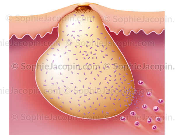 Bouton d'acné avec présence de P. acnes, la bactérie responsable du développement de l'acné inflammatoire - © sophie jacopin
