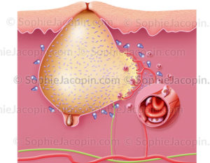 Acné, réaction immunitaire, bouton d'acné rétentionnel - © sophie jacopin