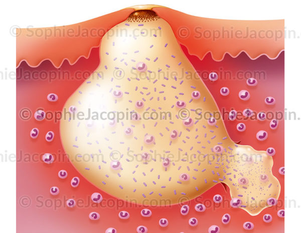 Acné inflammatoire due à l'accumulation de sébum et de P acnes dans le canal pilo-sébacé ayant déclanché une réaction immunitaire - © sophie jacopin