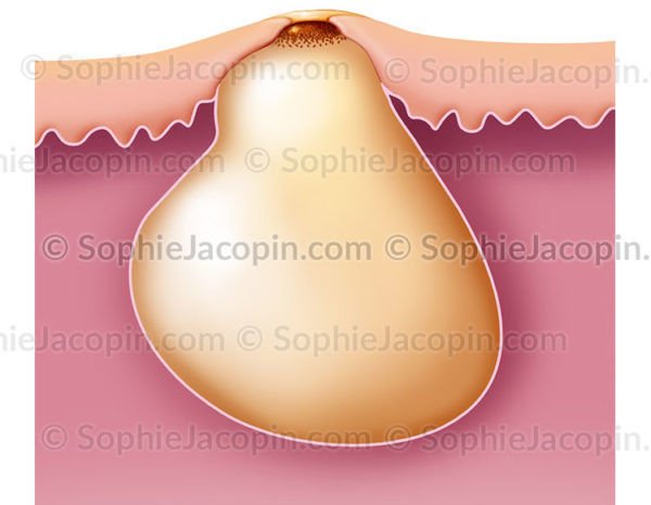 Acné rétentionelle ou formation d'un bouton d'acné avec accumulation de sébum dans le canal pilo-sébacé © sophie jacopin