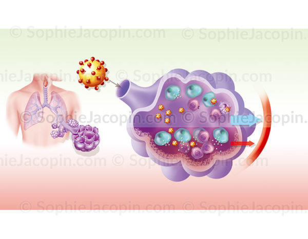 Citokines et réponse inflammatoire localisée dans les alvéoles pulmonaires - © sophie jacopin