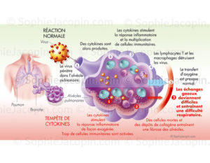 Tempete cytokinique et réponse inflammatoire localisée dans les alvéoles pulmonaires - © sophie jacopin