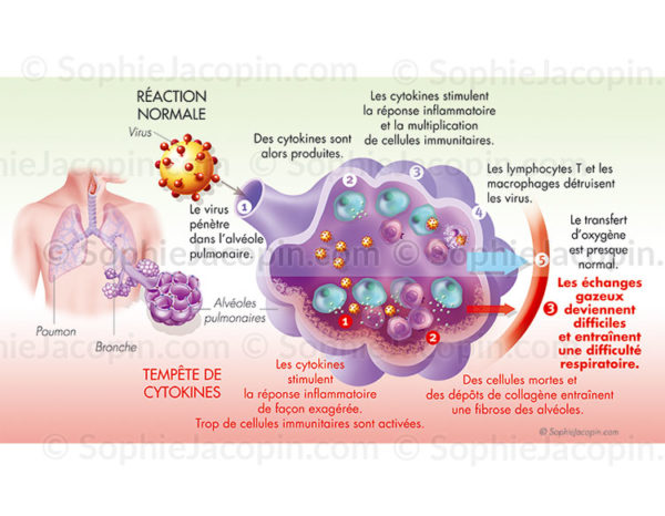 Tempete cytokinique et réponse inflammatoire localisée dans les alvéoles pulmonaires - © sophie jacopin