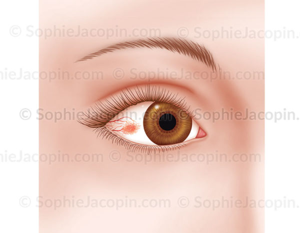 Episclerite, pathologie de l'œil, infection, agression oculaire - © sophie jacopin