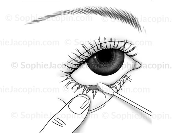 Prélèvement des sécrétions lacrymales, examen par écouvillon - © sophie ajcopin