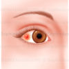 Sclérite, pathologie de l'œil, infection, agression oculaire - © sophie jacopin