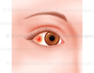 Sclérite, pathologie de l'œil, infection, agression oculaire - © sophie jacopin