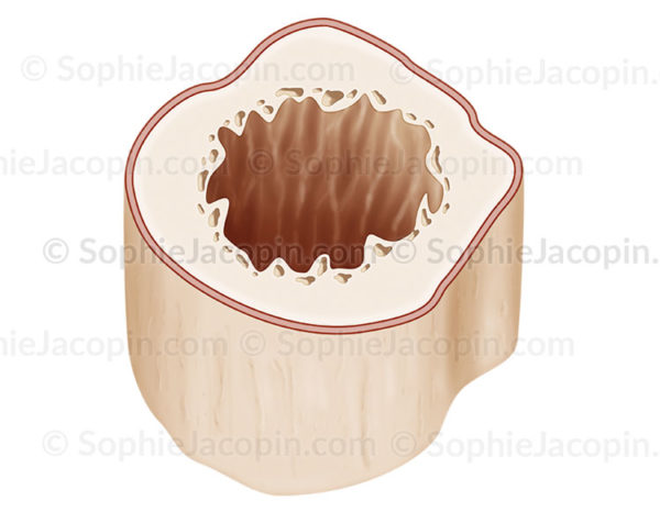 Coupe horizontale d’un os chez le nourrisson, structure osseuse, pédiatrie. - © sophie jacopin