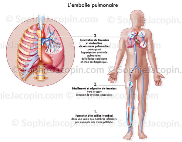Embolie pulmonaire, thrombus, obstruction d'un vaisseau pulmonaire.