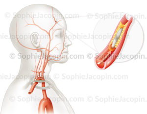 Ischémie transitoire ou accident ischémique transitoire au niveau d'une petite artère du cerveau du à un thrombus - © sophie jacopin