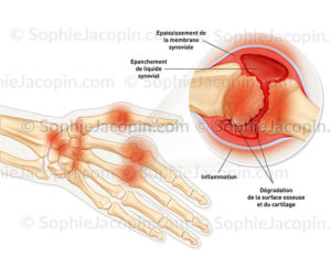 Polyarthrite rhumatoïde, pathologie articulaire provoquant une inflammation et déformation des articulations - © sophie jacopin