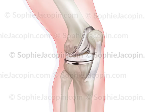 Prothèse du genou , pathologie de l'articulation avec atteinte osseuse et cartilagineuse - © sophie jacopin