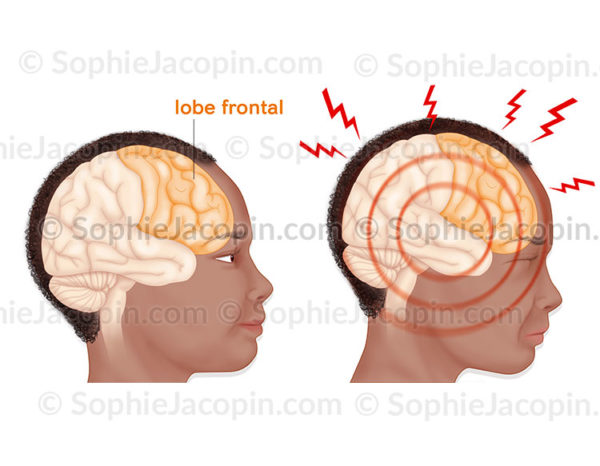 Surcharge mentale, comparaison entre à droite un cerveau avec une activité cérébrale normale et à gauche l'illustration d'une surcharge mentale - © sophie jacopin