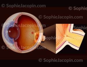 Représentation de l’anatomie d’un œil normal en coupe 3/4 avant. avec zoom montrant une papille optique et un nerf optique normaux - © sophie jacopin