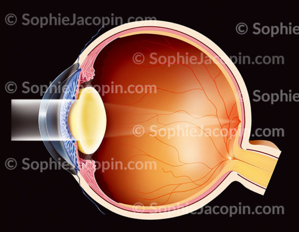 Cataracte, pathologie oculaire. Un œil atteint de cataracte présente un cristallin opacifié d'aspect laiteux qui ne laisse plus passer la lumière jusqu'à la rétine correctement - © sophie jacopin