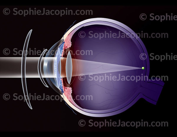 Corrections possibles sur une œil presbyte : verres de lunette, lentilles externes, lentille intra-oculaire de la chambre antérieure - © sophie jacopin