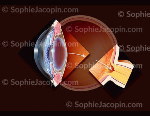 Coupe d’un œil glaucomateux, glaucome à angle ouvert et papille glaucomateuse, destruction progressive du nerf optique, atteinte du champs visuel - © sophie jacopin