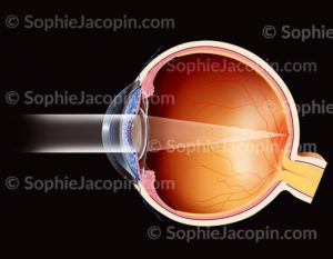 Glaucome et cataracte, une chirurgie combinée replaçant le cristallin par un implant intraoculaire - © sophie jacopin