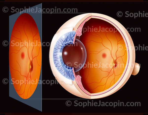 Examen du fond d’œil pratiqué pour vérifier la présence d’un glaucome. À gauche ,le résultat lors de l’examen de fond d’œil - c sophie jacopin