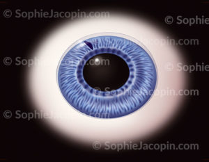 Glaucome , iridectomie au laser, opération qui consiste à faire une petite incision dans l’iris permettant l'évacuation de l'humeur aqueuse - © sophie jacopin