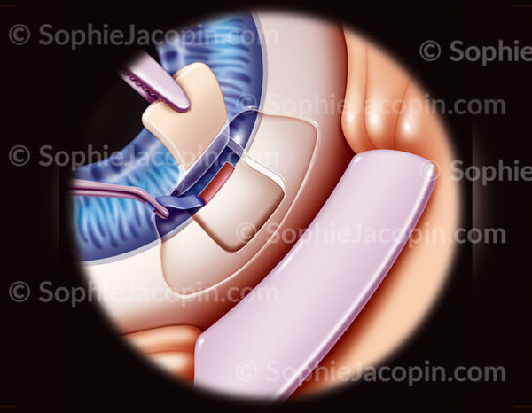 Splénectomie, ablation par chirurgie d'une partie de trabéculum en traitement contre le glaucome en passant par la sclère - © sophie jacopin