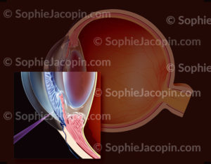 Traitement du glaucome par trabéculoplastie qui consiste à déboucher le trabéculum avec un laser afin de permettre l’évacuation de l’humeur aqueuse - © sophie jacopin