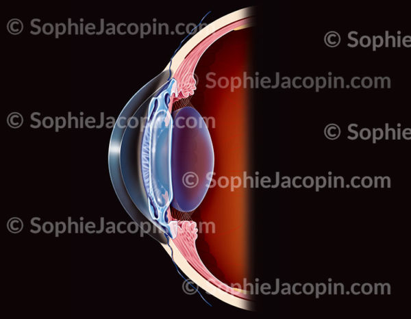 Implant intraoculaire mis en place dans la chambre antérieure de l'oeil entre la cornée et l'iris. Chirurgie réfractive pour la correction des troubles de la réfraction - © sophie jacopin