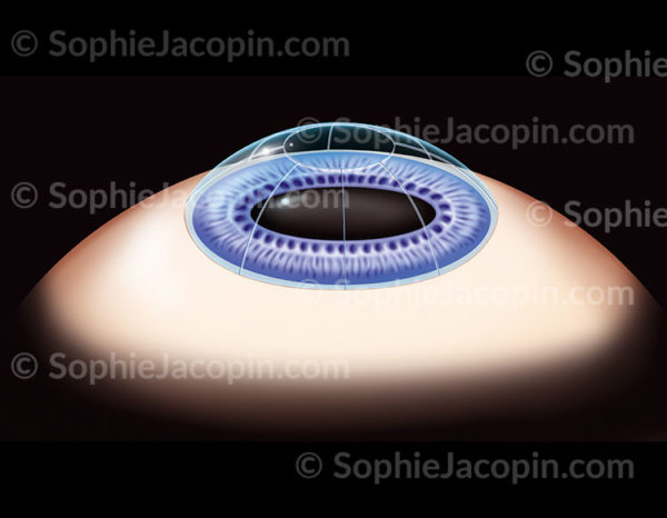 Représentation de l'opération de la kératotomie radiaire, incisions de la cornée grâce à un couteau diamant - © sophie jacopin